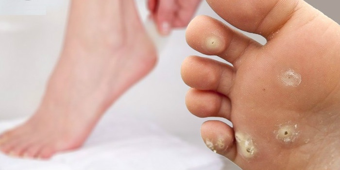 Get Rid Of Corns on Feet Naturally