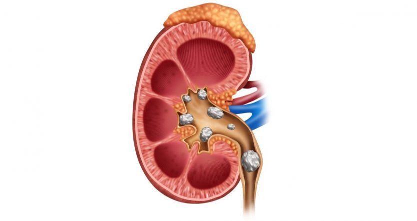 kidney stone