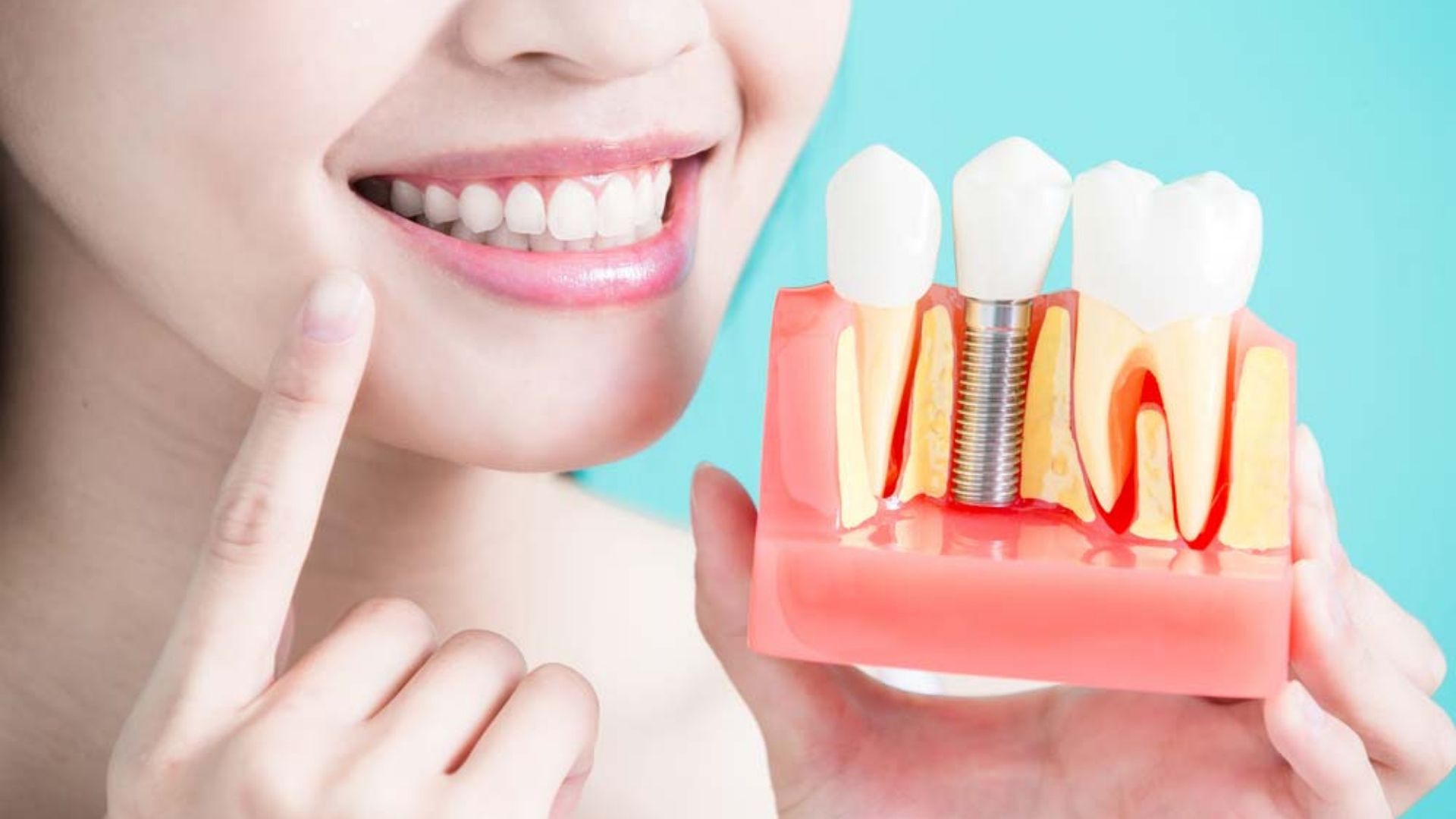 dental implant (2)