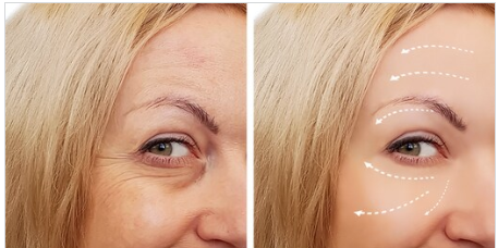 wrinkle reduction