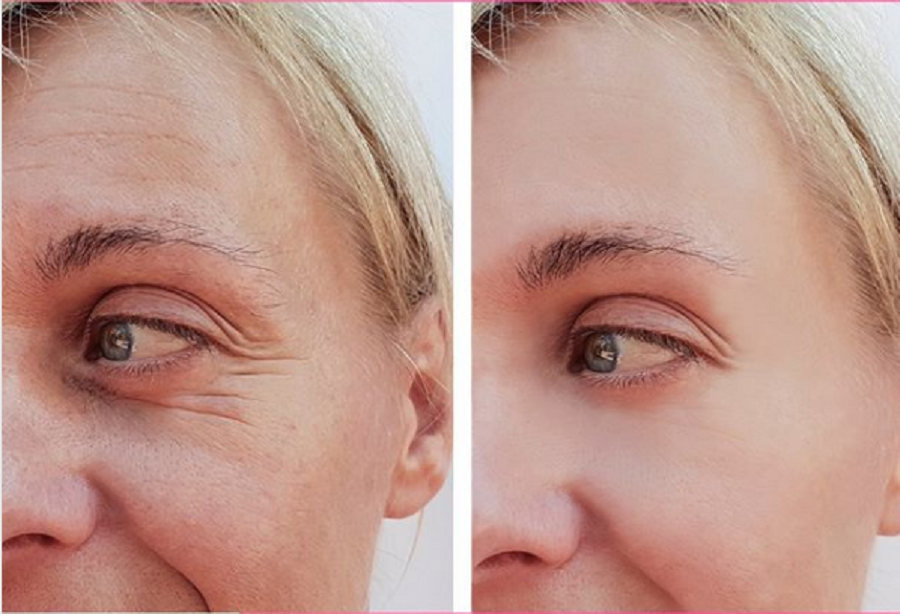 Wrinkle Injections treatment