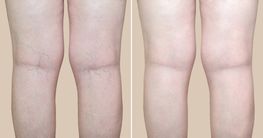 Laser vein treatment