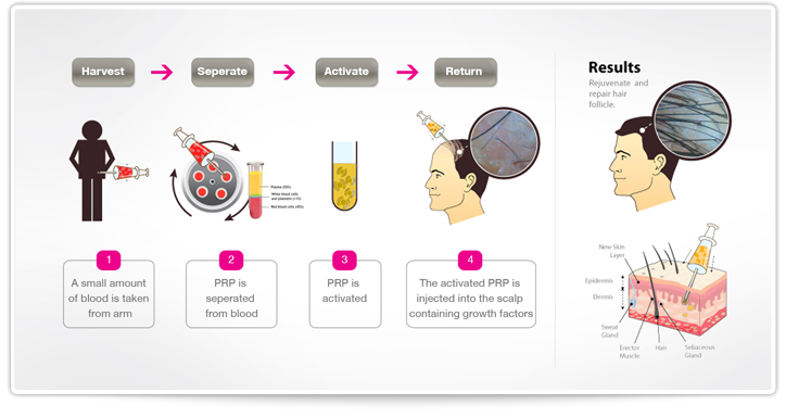 how-prp-works