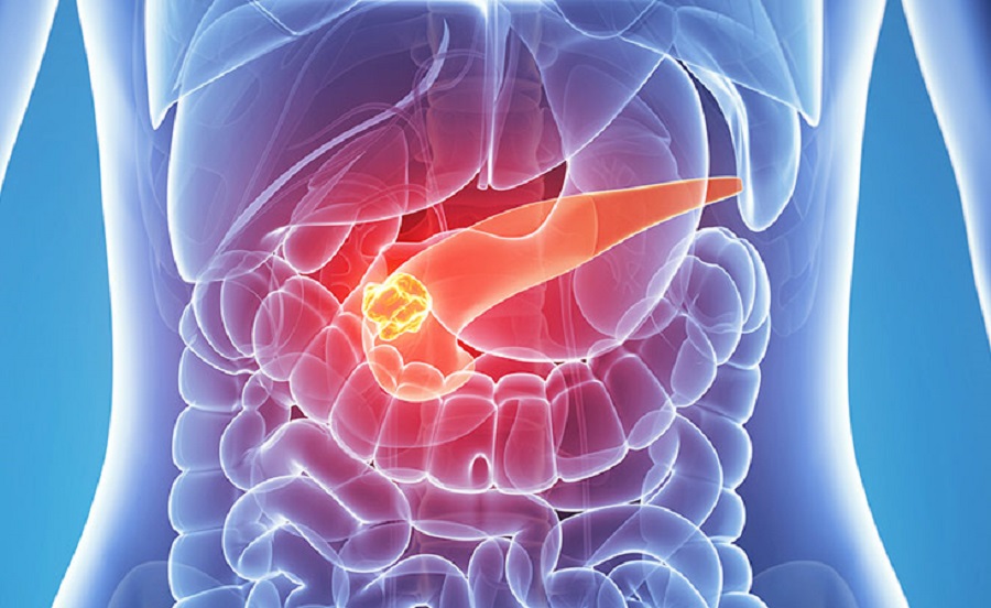 Neuroendocrine Tumors