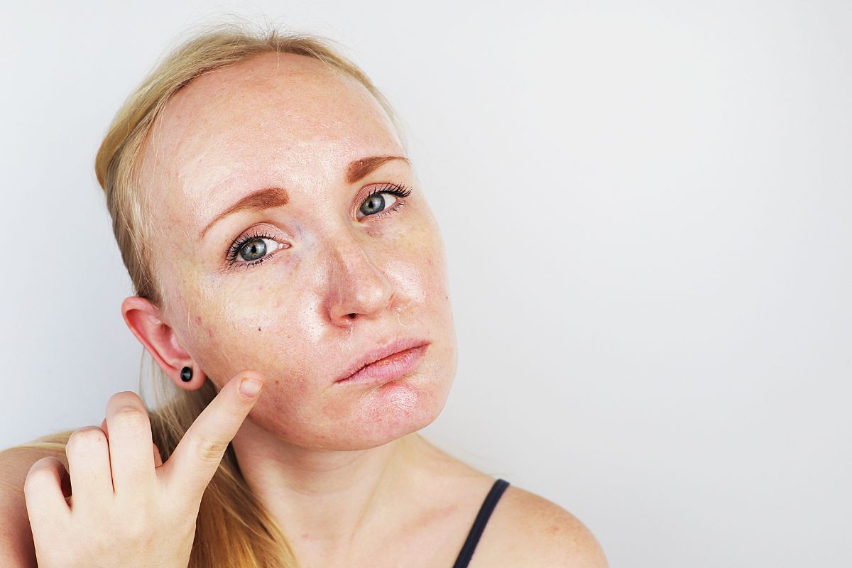 Dry Skin