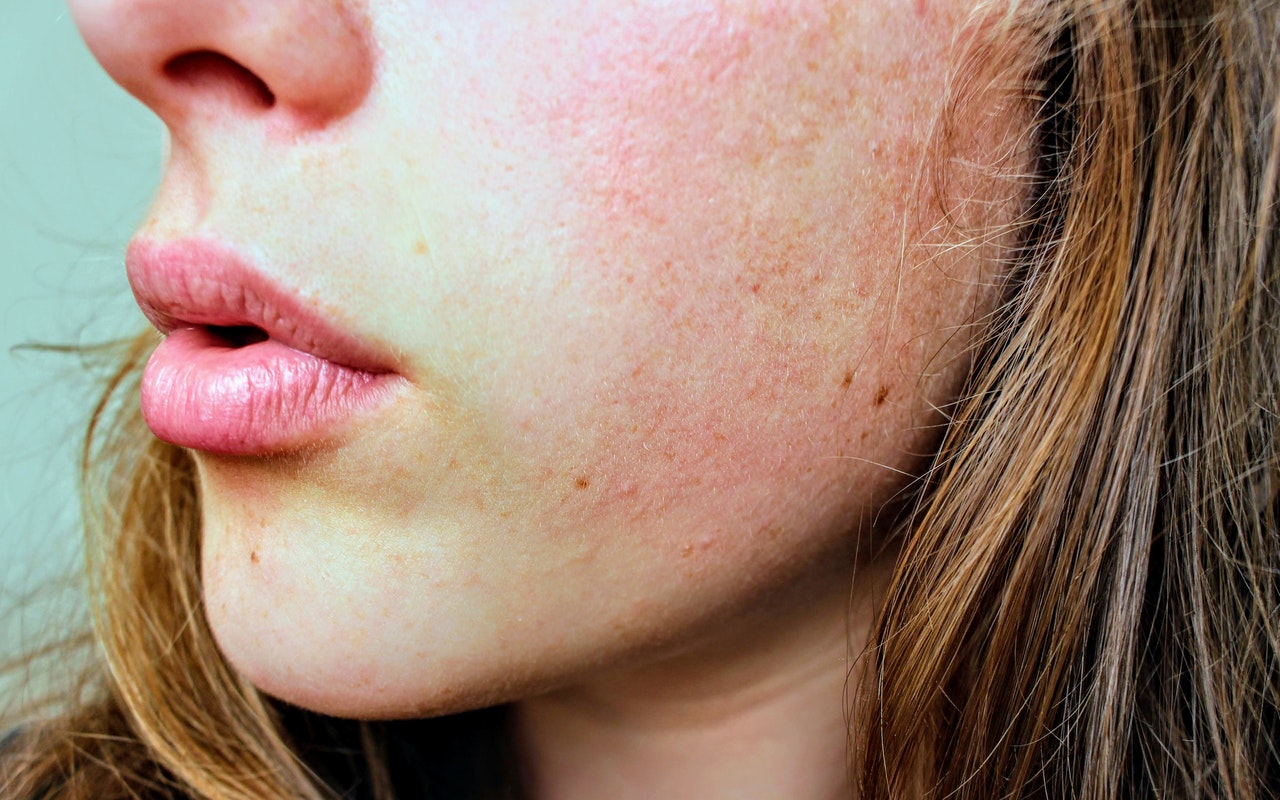 Eczema, and Dry Skin