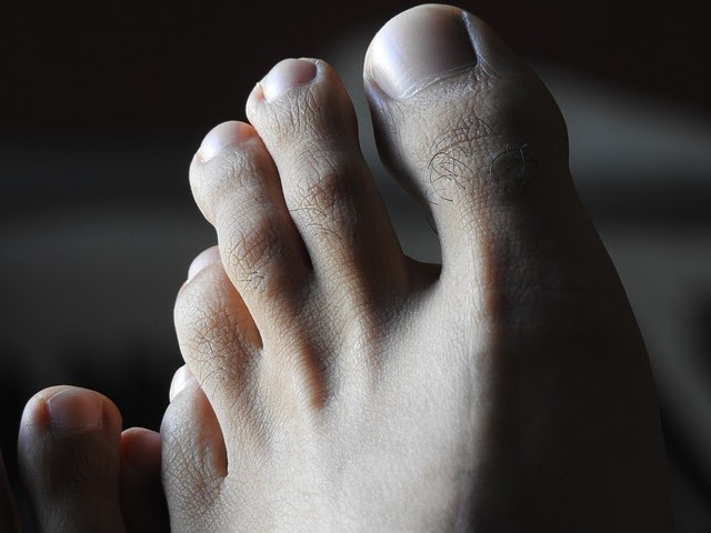 hammertoe surgery