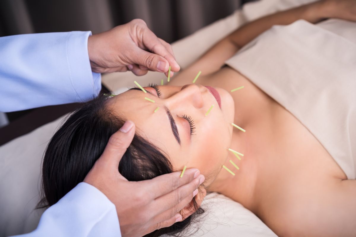 acupuncture