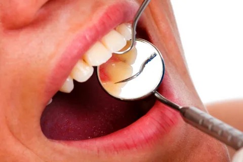 Gum Diseases