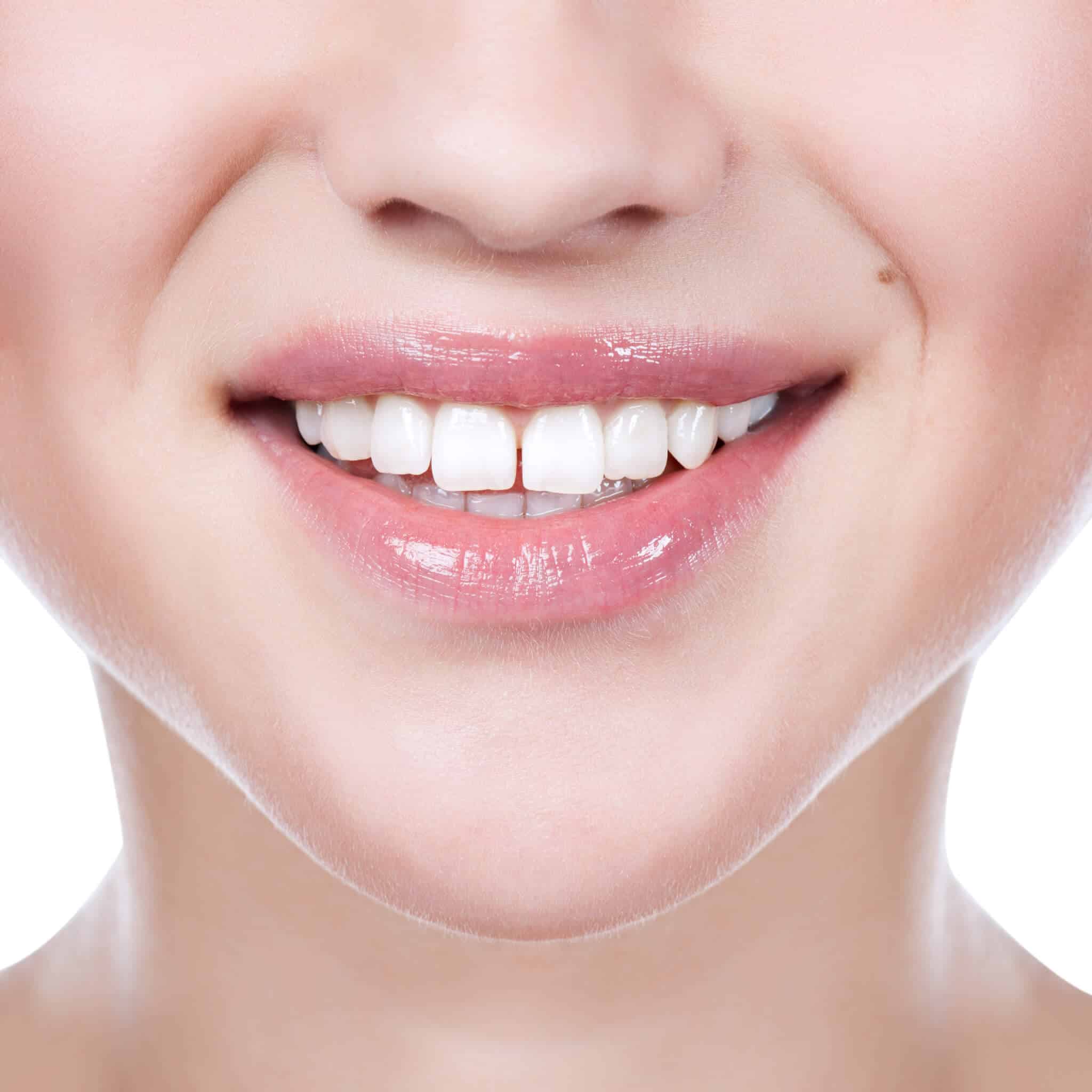 How to Fill Gaps Between Teeth: Your Guide to Diastema