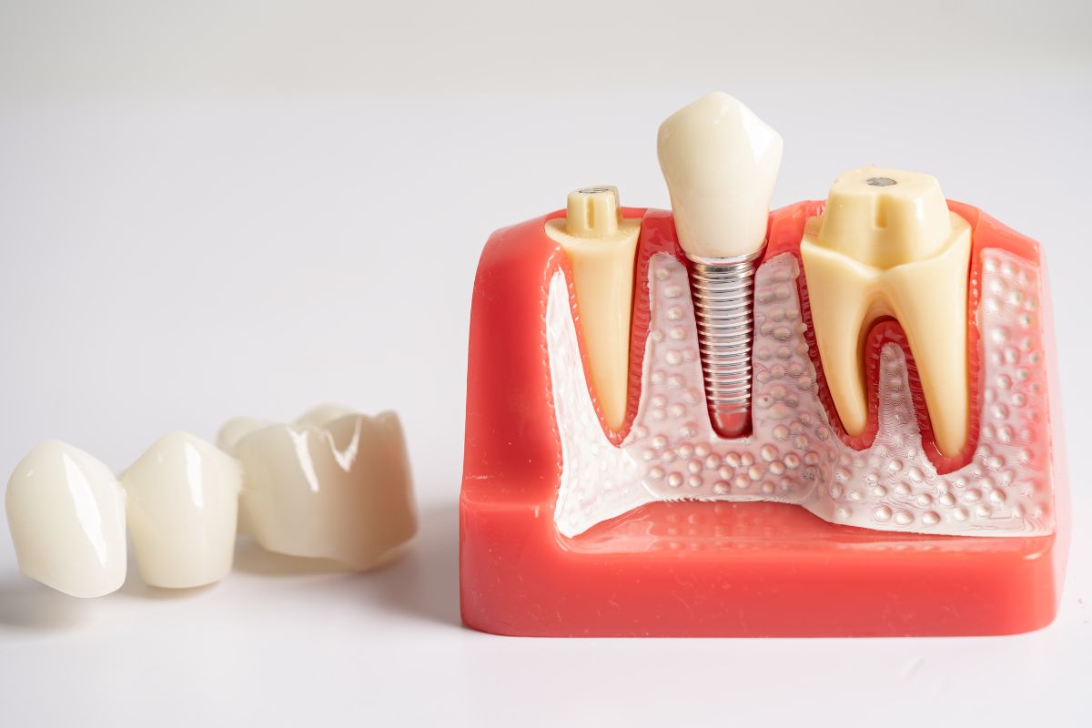 exposed tooth
