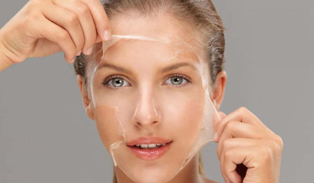 chemical peel