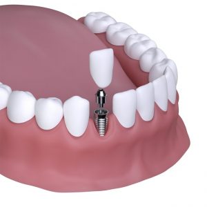 Dental Implant