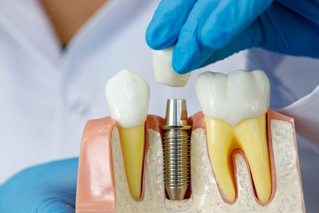 dental implants