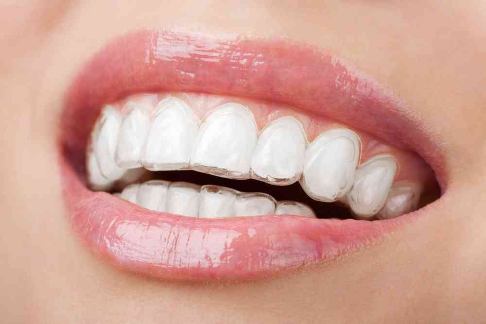 dental braces