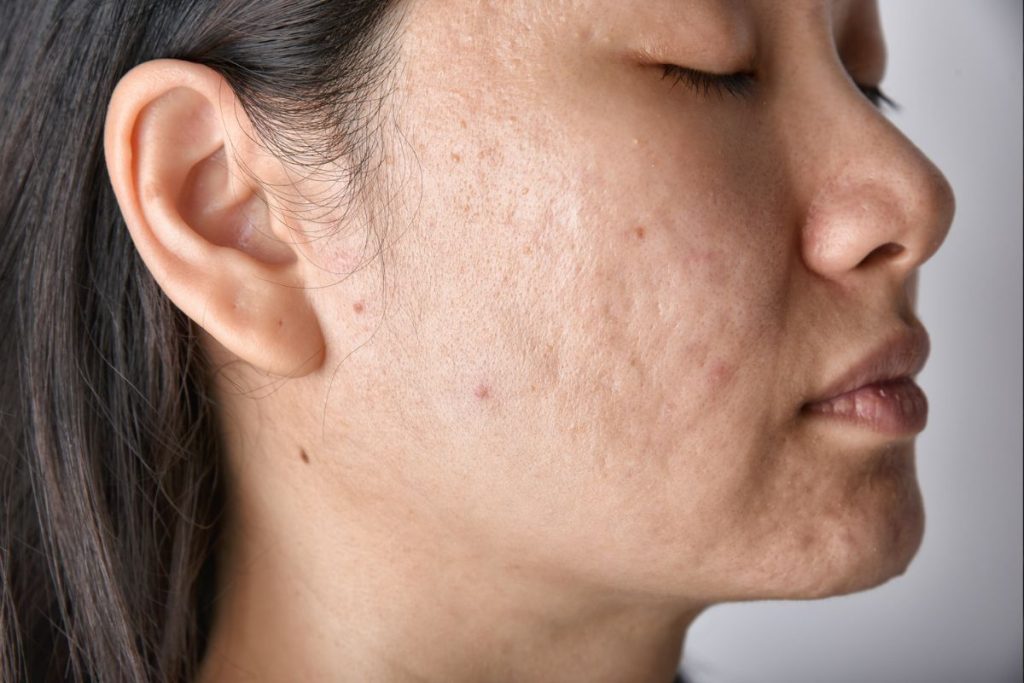 acne scar removal