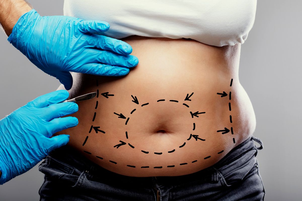 liposuction surgery