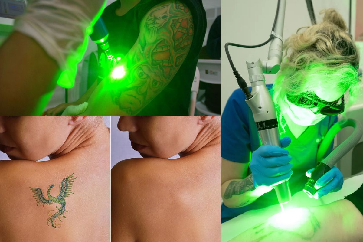 Color tattoo removal