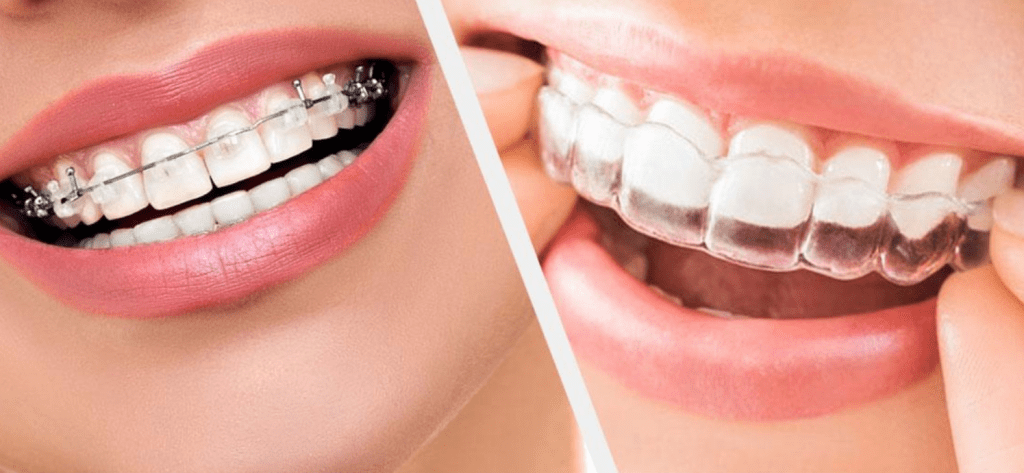 Orthodontic Treatment