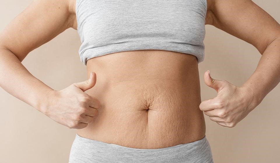 Tummy Tuck