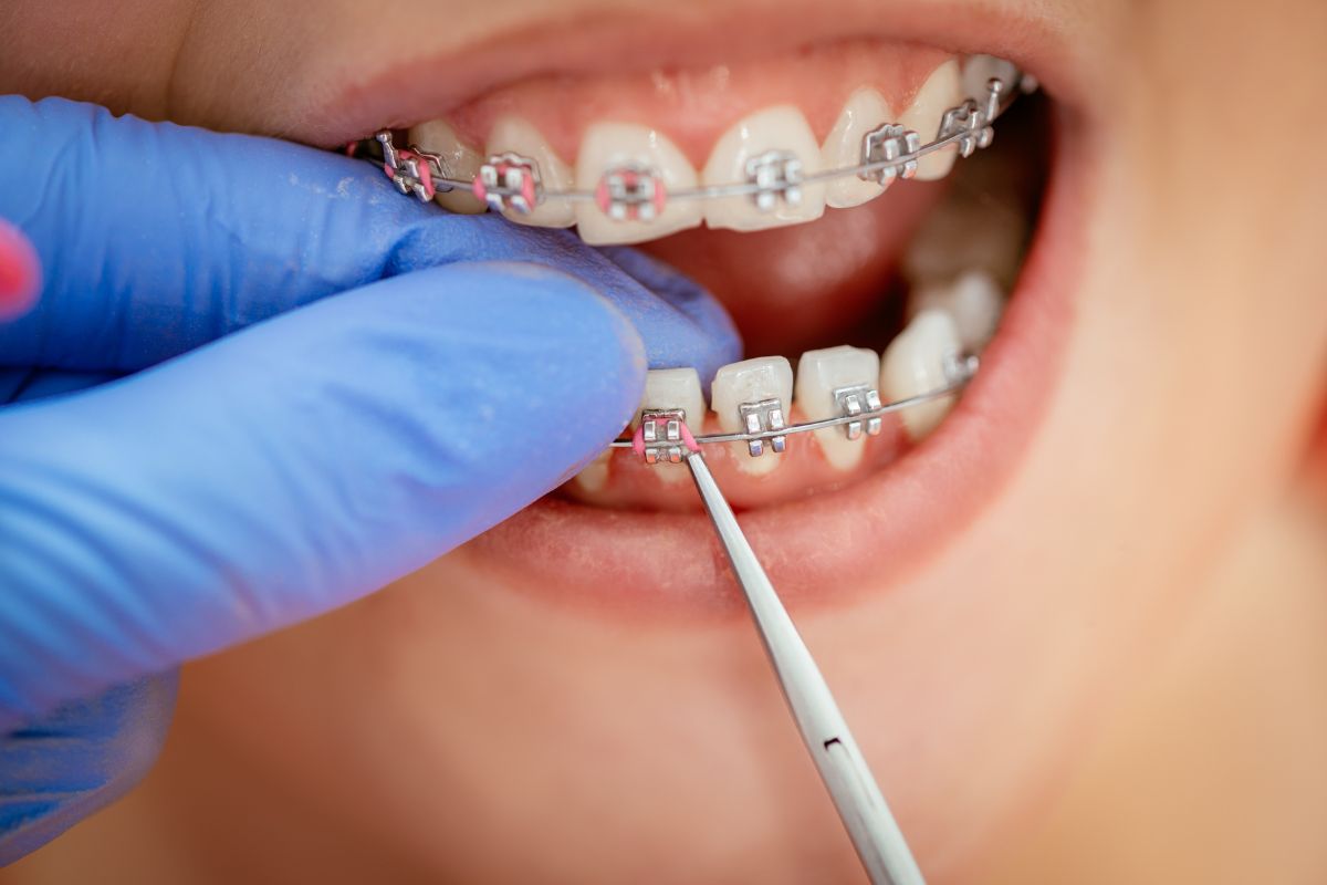 Dental Braces