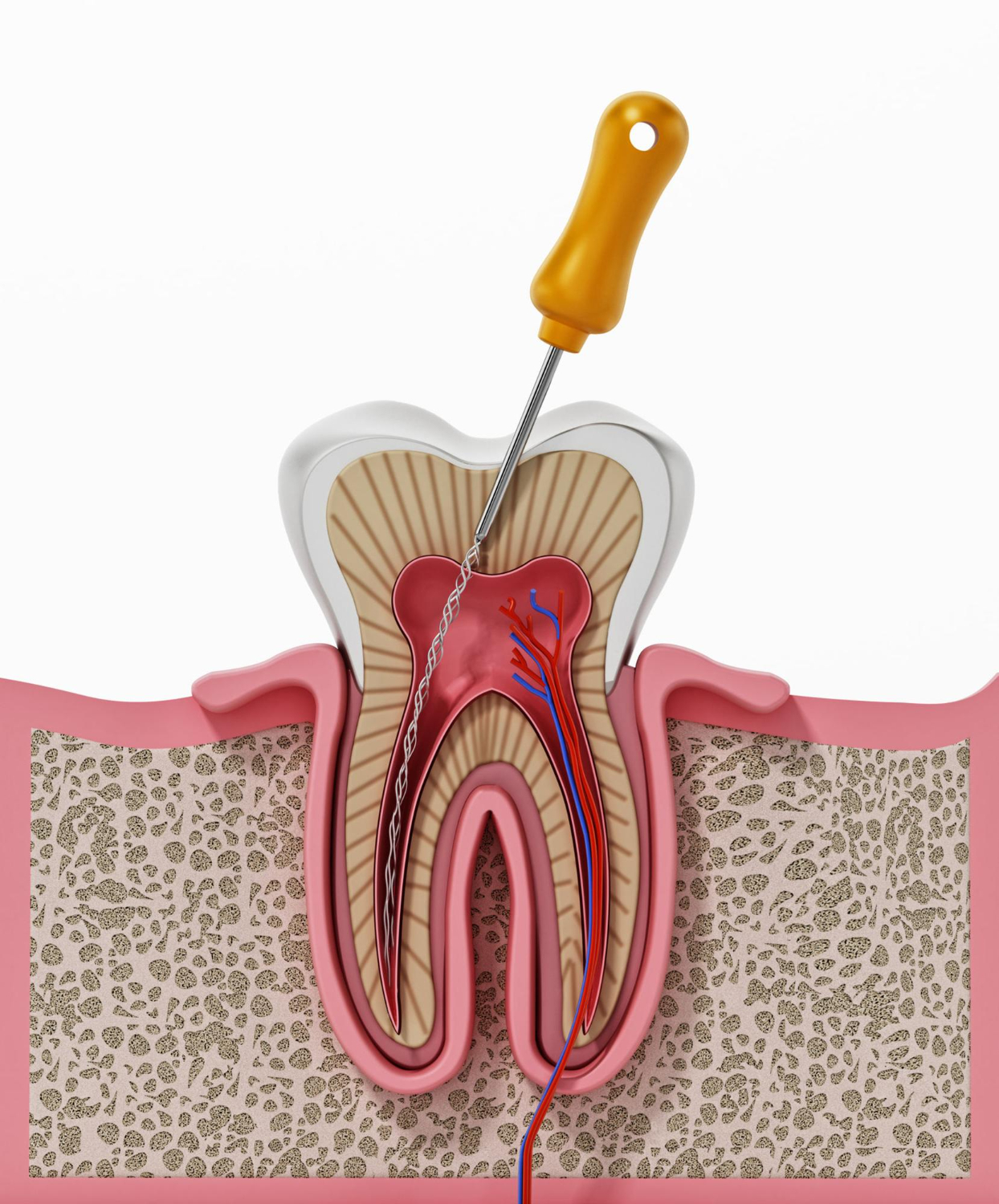 Root canal process