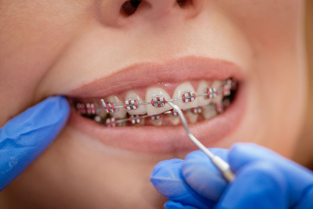 Braces Tightening