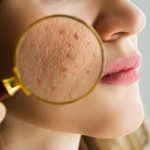Skin Barrier