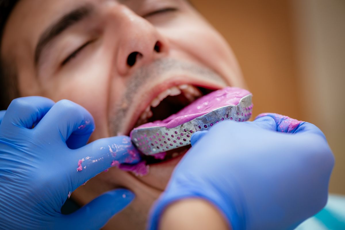 Dental Impressions