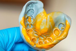 Dental Impressions