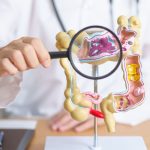 What is Colon Cancer