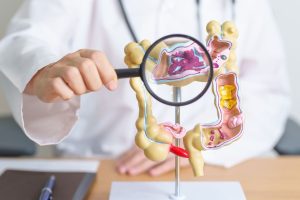 What is Colon Cancer