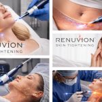 Renuvion Skin Tightening